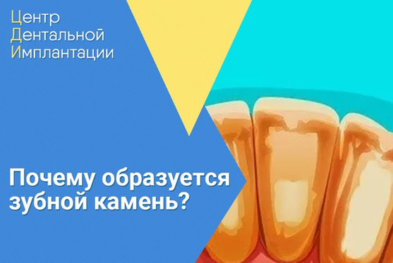 Почему образуется зубной камень