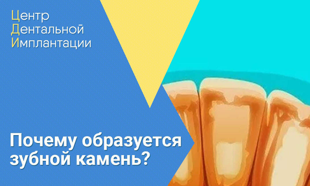 Почему образуется зубной камень и налёт