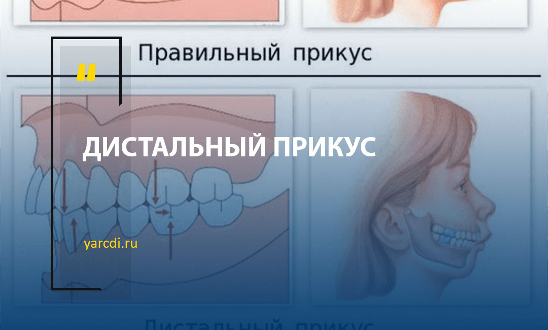 Дистальный прикус — неправильный прикус