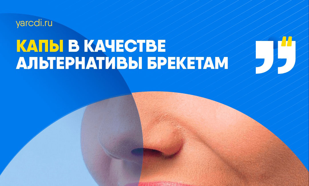 Капы в качестве альтернативы брекетам