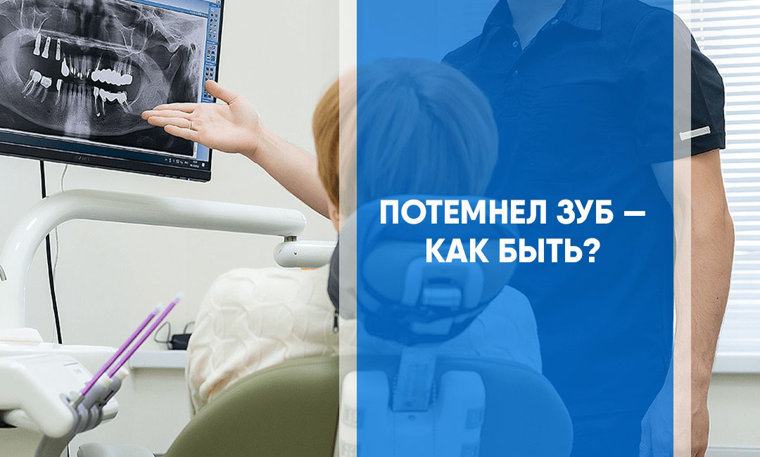 Потемнел зуб — причины и рекомендации